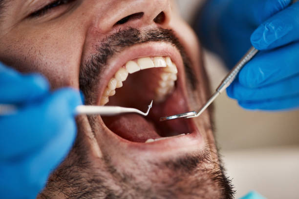 Best Emergency Wisdom Teeth Removal in Gillett, WI